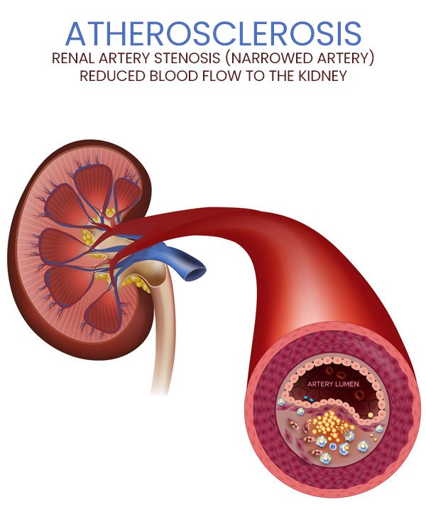Renal Artery Stenosis Specialist
